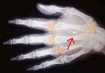 BIO CHIP IN HAND